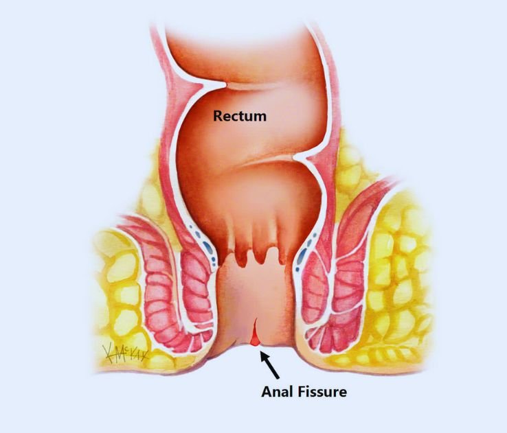 Fissures
