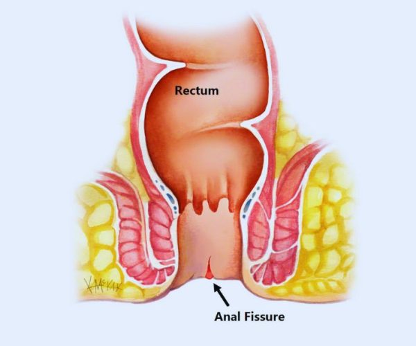Fissures Fissures